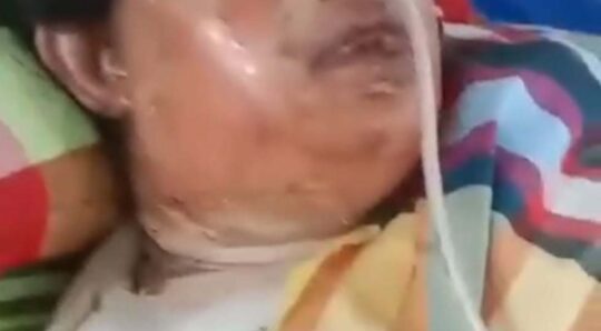 চৌদ্দগ্রামে স্বামীর দেওয়া আগুনে দ্বগ্ধ হয়ে চিকিৎসাধিন অবস্থায় গৃহবধূর মৃত্যু